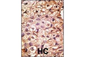 Formalin-fixed and paraffin-embedded human cancer tissue reacted with the primary antibody, which was peroxidase-conjugated to the secondary antibody, followed by AEC staining. (ACE2 Antikörper  (N-Term))