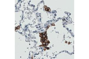 Immunohistochemical staining (Formalin-fixed paraffin-embedded sections) of human lung with MRC1 monoclonal antibody, clone CL0387  shows strong immunoreactivity in macrophages. (Macrophage Mannose Receptor 1 Antikörper)