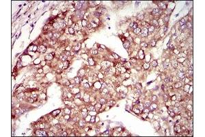 Immunohistochemical analysis of paraffin-embedded liver cancer tissues using MAP1LC3A mouse mAb with DAB staining. (MAP1LC3A Antikörper  (AA 1-121))