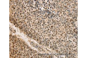 Immunohistochemistry of Human lung cancer using CDCA8 Polyclonal Antibody at dilution of 1:40 (CDCA8 Antikörper)