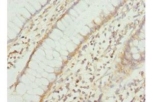 Immunohistochemistry of paraffin-embedded human colon cancer using ABIN7166573 at dilution of 1:100 (COX1 Antikörper  (AA 1-160))