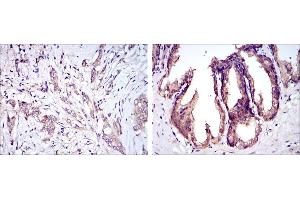 Immunohistochemical analysis of paraffin-embedded breast cancer tissues (left) and prostate tissues (right) using MAP3K5 mouse mAb with DAB staining. (ASK1 Antikörper)