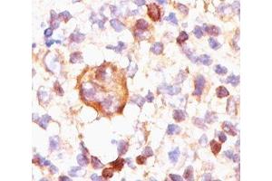 IHC testing of Hodgkin's lymphoma stained with Bcl-X antibody (BX006). (BCL2L1 Antikörper)