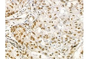 Phospho-EEF1A2 (Ser358) Antibody at 1/100 staining Human liver cancer by IHC-P.