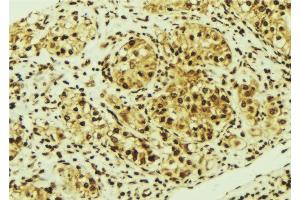 ABIN6276841 at 1/100 staining Human breast cancer tissue by IHC-P. (MED1 Antikörper  (Internal Region))