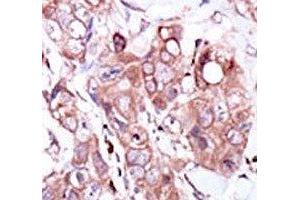 IHC analysis of FFPE human breast carcinoma tissue stained with the ERBB4 antibody