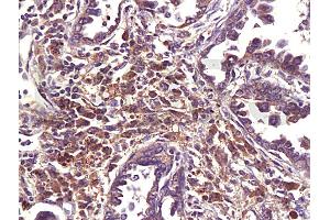 Formalin-fixed and paraffin embedded human lung carcinoma labeled with Anti-MDR1/p-GP/CD243 Polyclonal Antibody (ABIN670161), Unconjugated 1:200 at 1:200, followed by conjugation to the secondary antibody and DAB staining