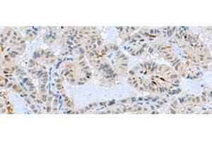 Immunohistochemistry of paraffin-embedded Human thyroid cancer tissue using TCF19 Polyclonal Antibody at dilution of 1:60(x200) (TCF19 Antikörper)