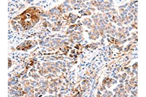 The image on the left is immunohistochemistry of paraffin-embedded Human breast cancer tissue using ABIN7190683(FOXD2 Antibody) at dilution 1/10, on the right is treated with synthetic peptide. (FOXD2 Antikörper)