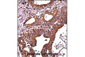 RIPK1 Antibody (N-term) ((ABIN657814 and ABIN2846781))immunohistochemistry analysis in formalin fixed and paraffin embedded human prostate carcinoma followed by peroxidase conjugation of the secondary antibody and DAB staining. (RIPK1 Antikörper  (N-Term))