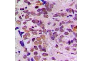 Immunohistochemical analysis of ATF1 staining in human breast cancer formalin fixed paraffin embedded tissue section. (AFT1 Antikörper  (C-Term))