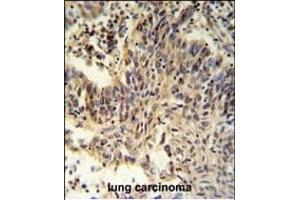 RXRA Antibody (Center) (ABIN651113 and ABIN2840079) IHC analysis in formalin fixed and paraffin embedded lung carcinoma followed by peroxidase conjugation of the secondary antibody and DAB staining. (Retinoid X Receptor alpha Antikörper  (AA 196-224))