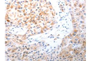 The image on the left is immunohistochemistry of paraffin-embedded Human lung cancer tissue using ABIN7191313(LPPR5 Antibody) at dilution 1/20, on the right is treated with synthetic peptide. (LPPR5 Antikörper)