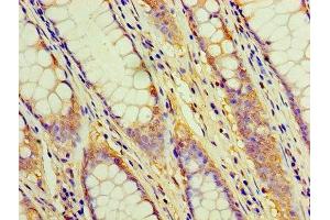 Immunohistochemistry of paraffin-embedded human colon cancer using ABIN7171365 at dilution of 1:100 (CD2 Antikörper  (AA 25-209))