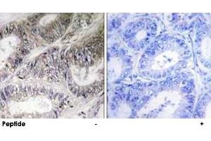 Immunohistochemistry analysis of paraffin-embedded human colon carcinoma tissue using COX19 polyclonal antibody .