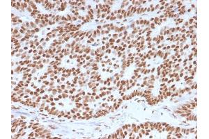 Formalin-fixed, paraffin-embedded human Breast Carcinoma stained with Estrogen Receptor alpha Mouse Monoclonal Antibody (ESR1/3557). (Estrogen Receptor alpha Antikörper  (AA 129-312))