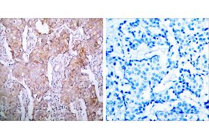 Immunohistochemical analysis of paraffin- embedded breast carcinoma, using EGFR (Phospho-Ser1070) Antibody. (EGFR Antikörper  (pSer1070))