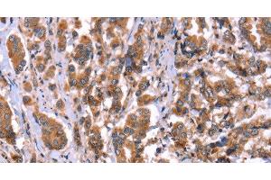 Immunohistochemistry of paraffin-embedded Human breast cancer tissue using HRG Polyclonal Antibody at dilution 1:50 (HRG Antikörper)