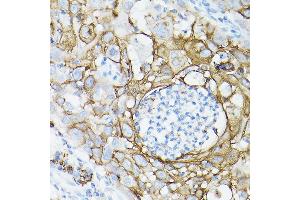 Immunohistochemistry of paraffin-embedded human lung cancer using MUC1 Rabbit mAb (ABIN7268687) at dilution of 1:100 (40x lens). (MUC1 Antikörper)