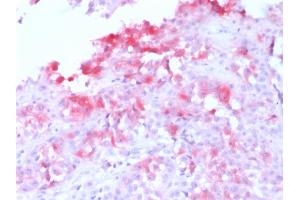 Formalin-fixed, paraffin-embedded human Melanoma stained with MART-1 Rabbit Recombinant Monoclonal Antibody (MLANA/1761R) (AP-Fast Red). (Rekombinanter MLANA Antikörper)