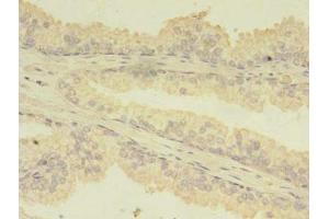 Immunohistochemistry of paraffin-embedded human prostate cancer using ABIN7173738 at dilution of 1:100