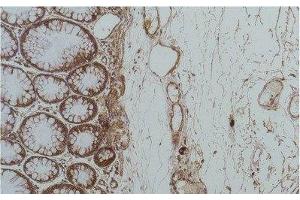 Immunohistochemistry of paraffin-embedded Human colon carcinoma tissue using HSPA5 Monoclonal Antibody at dilution of 1:200. (GRP78 Antikörper)