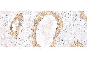 Immunohistochemistry of paraffin-embedded Human breast cancer tissue using TOR1A Polyclonal Antibody at dilution of 1:35(x200)