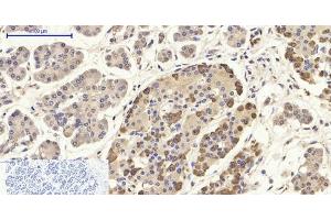 Immunohistochemistry of paraffin-embedded Human stomach cancer tissue using CD284 Polyclonal Antibody at dilution of 1:200. (TLR4 Antikörper)