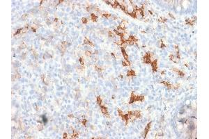 Formalin-fixed, paraffin-embedded human Melanoma stained with NGFR Rabbit Recombinant Monoclonal Antibody (NGFR/1997R). (Rekombinanter NGFR Antikörper)