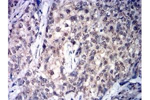 Immunohistochemical analysis of paraffin-embedded cervical cancer tissues using SDHB mouse mAb with DAB staining.