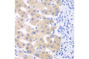 Immunohistochemistry of paraffin-embedded human liver cancer using CYP2C18 antibody. (CYP2C18 Antikörper  (AA 231-490))