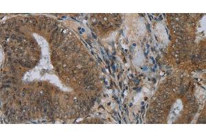 Immunohistochemistry of paraffin-embedded Human colon cancer using NAT10 Polyclonal Antibody at dilution of 1:40