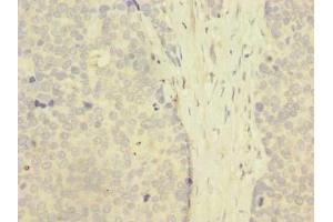 Immunohistochemistry of paraffin-embedded human gastric cancer using ABIN7176509 at dilution of 1:100 (ZNF77 Antikörper  (AA 51-369))