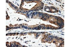 Immunohistochemical staining of paraffin-embedded Adenocarcinoma of colon tissue using anti-FAHD2Amouse monoclonal antibody. (FAHD2A Antikörper)