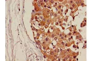 Immunohistochemistry of paraffin-embedded human breast cancer using ABIN7146220 at dilution of 1:100 (CDH18 Antikörper  (AA 66-251))