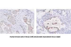 Paraffin embedded sections of human breast cancer and prostate hyperplasia tissue were incubated with anti-human STEAP1 (1:50) for 2 hours at room temperature. (STEAP1 Antikörper  (AA 1-70))