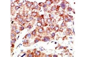 IHC analysis of FFPE human hepatocarcinoma stained with the NEDD8 antibody (NEDD8 Antikörper  (AA 1-32))
