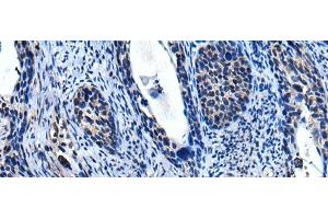 Immunohistochemistry of paraffin-embedded Human cervical cancer tissue using TRIM23 Polyclonal Antibody at dilution of 1:55(x200) (TRIM23 Antikörper)