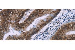 Immunohistochemistry of paraffin-embedded Human colon cancer tissue using HMGA1 Polyclonal Antibody at dilution 1:30 (HMGA1 Antikörper)