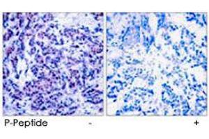 Immunohistochemical analysis of paraffin-embedded human breast carcinoma tissue using JUND (phospho S255) polyclonal antibody . (JunD Antikörper  (pSer255))