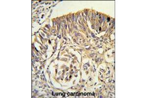 Formalin-fixed and paraffin-embedded human lung carcinoma reacted with PLTP Antibody , which was peroxidase-conjugated to the secondary antibody, followed by DAB staining. (PLTP Antikörper  (C-Term))