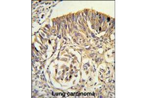 Formalin-fixed and paraffin-embedded human lung carcinoma reacted with PLTP Antibody , which was peroxidase-conjugated to the secondary antibody, followed by DAB staining.