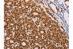 The image on the left is immunohistochemistry of paraffin-embedded Human thyroid cancer tissue using ABIN7130740(PSMD3 Antibody) at dilution 1/25, on the right is treated with fusion protein. (PSMD3 Antikörper)