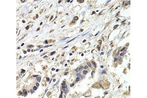 Immunohistochemistry of paraffin-embedded Human breast cancer using BUB1B Polyclonal Antibody at dilution of 1:200 (40x lens). (BUB1B Antikörper)