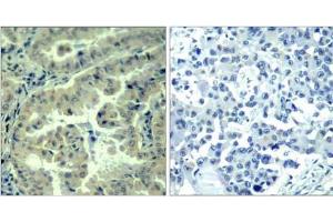 Immunohistochemical analysis of paraffin-embedded human lung carcinoma tissue using eIF4G (phospho-Ser1232) antibody (E011514). (EIF4G1 Antikörper  (pSer1232))