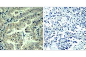 Immunohistochemical analysis of paraffin-embedded human lung carcinoma tissue using eIF4G (phospho-Ser1232) antibody (E011514). (EIF4G1 Antikörper  (pSer1232))