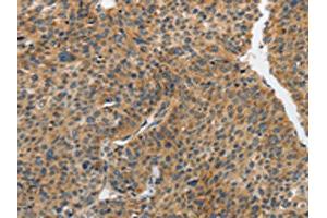 The image on the left is immunohistochemistry of paraffin-embedded Human liver cancer tissue using ABIN7191891(PIP5K1C Antibody) at dilution 1/25, on the right is treated with synthetic peptide. (PIP5K1C Antikörper)