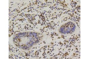 Immunohistochemistry of paraffin-embedded human mammary cancer using CREB1 antibody (ABIN5996963) at dilution of 1/100 (40x lens). (CREB1 Antikörper)