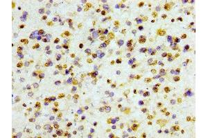 IHC image of ABIN7127295 diluted at 1:100 and staining in paraffin-embedded human glioma cancer performed on a Leica BondTM system. (Rekombinanter HIST1H3A Antikörper)