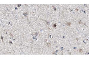 ABIN6277974 at 1/100 staining Human brain cancer tissue by IHC-P. (Presenilin 2 Antikörper  (Internal Region))